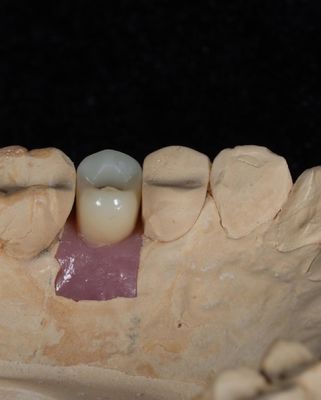 Implante de cemento de tornillo para implantes dentales de larga duración con garantía de 5 años