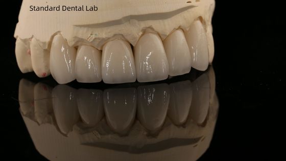 Coronilla de zirconio de contorno completo y puente dental natural de alta estética 5 años de garantía