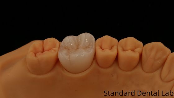 Noritake porcelana de contorno completo corona de zirconia personalizada sombra de vita para la restauración dental digital estética por laboratorio dental