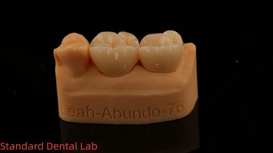 Coronas de laboratorio dentales sólidas 3D Pro de alta translucidez Coronas de zirconia completa con garantía de 5 años