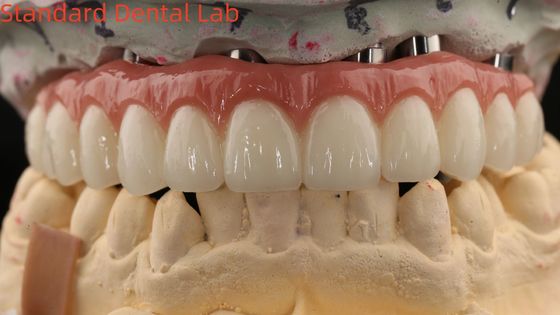 Porcelana todo en cuatro puente de zirconia alta estética puente de implantes dentales tornillo retenido