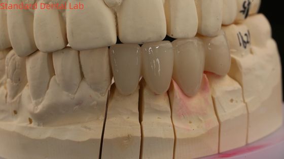 Coronas de laboratorio dentales sólidas 3D Pro de alta translucidez Coronas de zirconia completa con sombra de Vita personalizadas