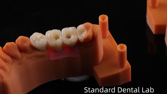 Corona de implantes dentales retenida por tornillo con PFZ porcelana en capas de zirconia de 5 años de garantía y modelo de impresión 3D