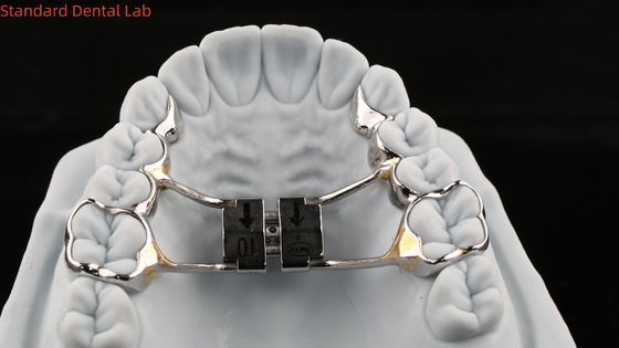 Arco de los dientes Expandidor del paladar Hyrax estable Expandidor del paladar Perfect Fit SDL Dental Laboratorio de ortodoncia