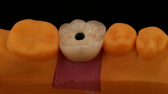 Coroa de implante dental de zircón de porcelana con capas de PFZ retenido por tornillo de laboratorio dental ISO FDA CE certificado con garantía de 5 años