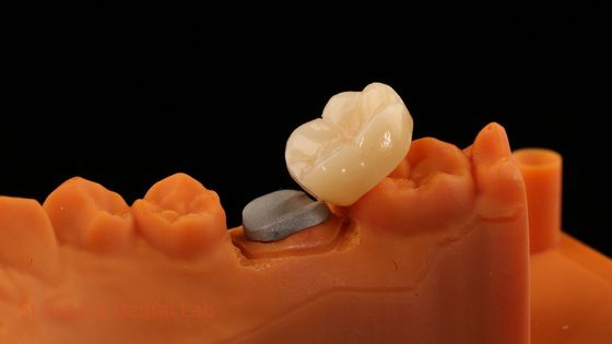 Corona de zirconio de contorno completo de alta estética con núcleo de post de metal 5 años de garantía y mejores técnicos de SDL Dental Lab