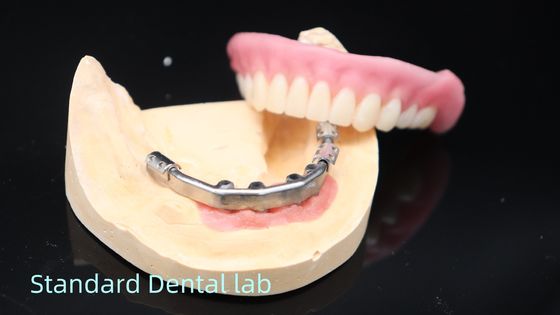 Dentaduras con apoyo de implantes de titanio Dentaduras de precisión Ivoclar sobre implantes