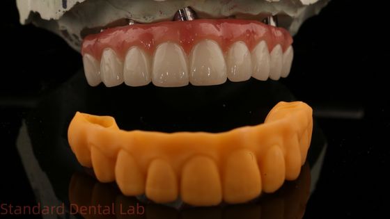 5 años de garantía Implante dental Corona PMMA Puente sobre abutments de unidades múltiples Sombra Vita personalizada