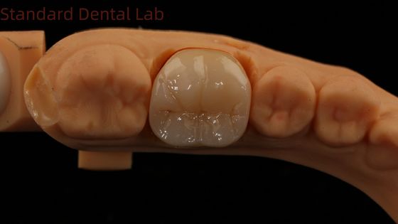 Dental Digital Corona completa de zircónia con modelo de impresión 3D de porcelana Noritake 5 años de garantía