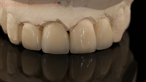 Corona y puente de zirconio de capa fuerte en buena estética laboratorio dental de zirconio de capa china