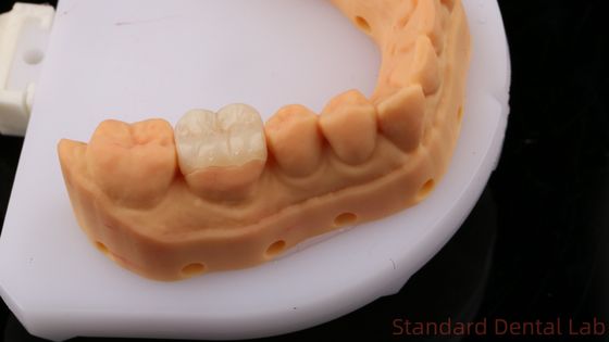 Enlace Dental de Zirconia Translúcido Coronilla Onlay para restaurar la forma natural de la cavidad / Laboratorio Dental Estándar
