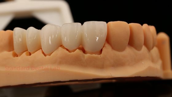 Dentes delanteros de alta estética con corona de zirconia de contorno completo con laboratorio dental Vita Shade personalizado