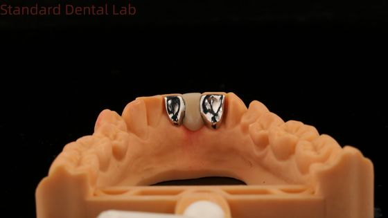 Dental PFM Puente de Maryland Alta Estética FDA Certificado con Vita Porcelan China Dental Lab