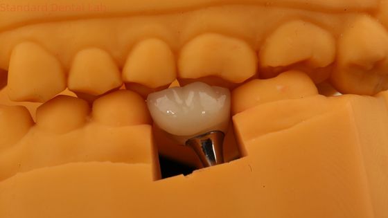 Coroa de implante dental con tornillo de retención Coroa dental PFM con modelo de impresión 3D