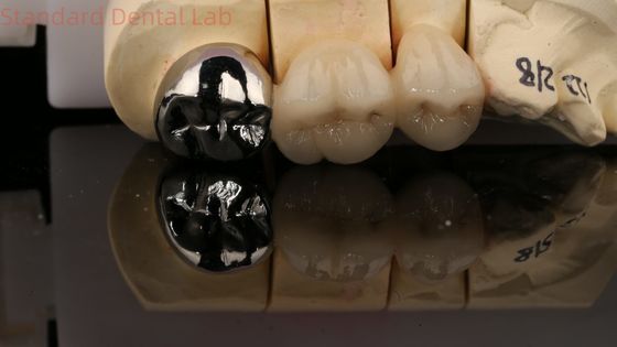 Corona de porcelana Vita con post núcleo 3 años de garantía del laboratorio dental