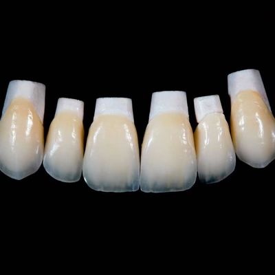 Coronilla de carillas de porcelana Emax de alta translucidez con mejores materiales por Ivoclar Vivadent