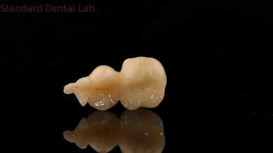 Dental Digital Corona completa de zirconia con modelo de impresión en 3D SDL Dental Lab Zirconia Onlay