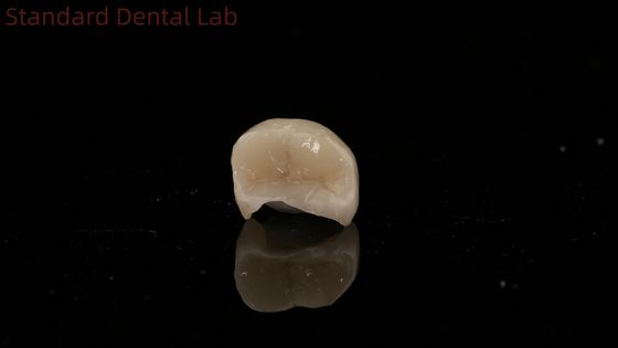 Translucidez Dental Corona de Zirconia Inlay Corona Onlay para restaurar la forma natural de la cavidad