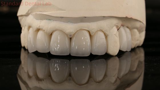 China Dental Lab Zirconia Corona de contorno completo Puente dental natural de alta estética 5 años de garantía