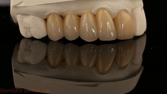 Noritake Porcelana de contorno completo Corona de zirconio de alta estética Puente dental de zirconio natural personalizado