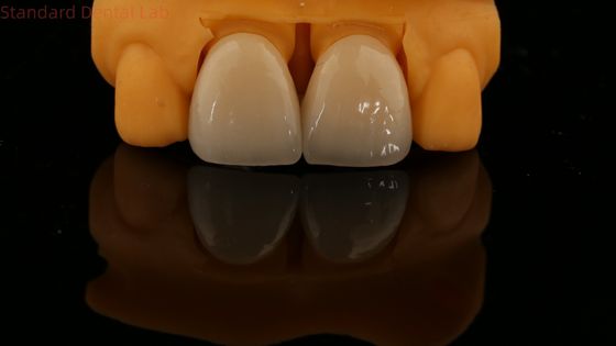 5 años de garantía de contorno completo corona de zircónía personalizada sombra de vita alta estética puente dental natural