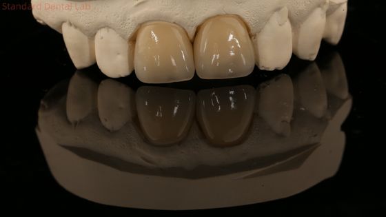Coronilla de zirconio de contorno completo y puente dental natural de alta estética 5 años de garantía
