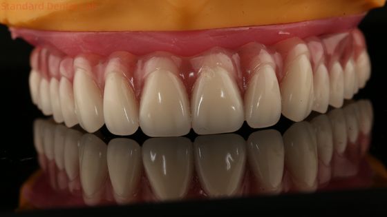 Implante parcial de acrílico sobre la dentadura postiza barra de ticianos dentadura completa dientes instalados tornillo retenido