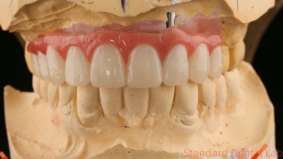 Bien ajustado Precisión Estética Zirconia Porcelana Corona Rosa Porcelana Con Sombra Blanqueadora