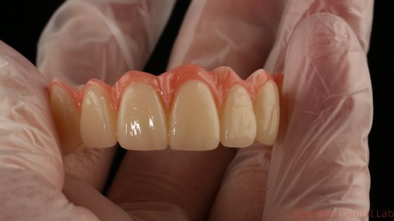 Porcelana todo en cuatro puente de zircónía alta estética puente de implantes dentales