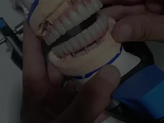 Puente Malo Hibrido Zirconia Todo en Cuatro / Seis Zirconia Puente Implante Titanio Barra