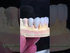 Emax Veneers de aspecto natural Corona Biocompatibilidad Sombra de blanqueamiento con una preparación mínima