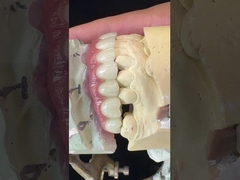Dentaduras con apoyo de implantes de titanio Dentaduras de precisión Ivoclar sobre implantes